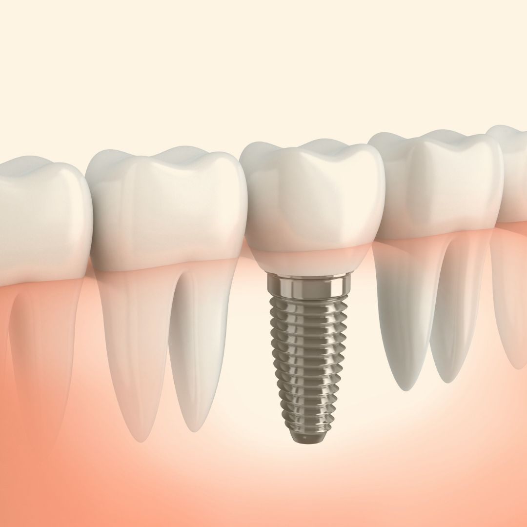 calgary ne dental implants