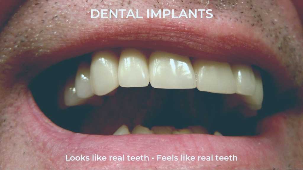 calgary ne dental implants
