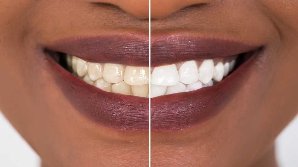 Teeth Whitening Calgary NE Skypointe Dental Cosmetic Dentistry