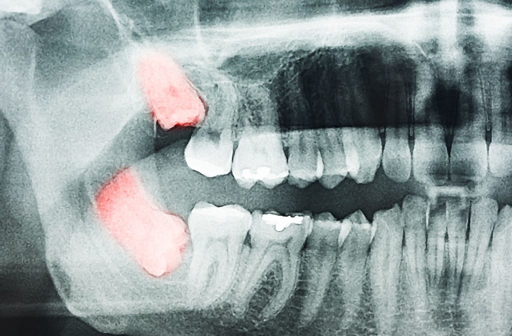 An x-ray of a misaligned wisdom tooth
